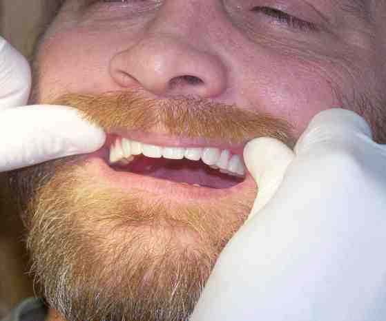 Staub Cranial Dentures Pacific Dentalworks