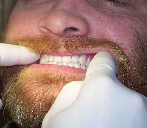Staub Cranial Dentures Pacific Dentalworks